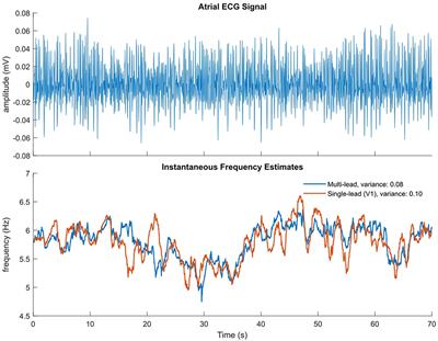 ECG-Based Indices to Characterize Persistent Atrial Fibrillation Before and During Stepwise Catheter Ablation